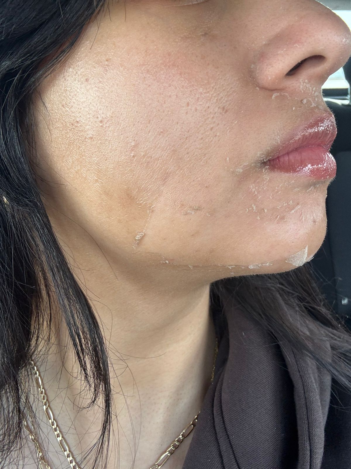 تفتيح مناطق حول الفم