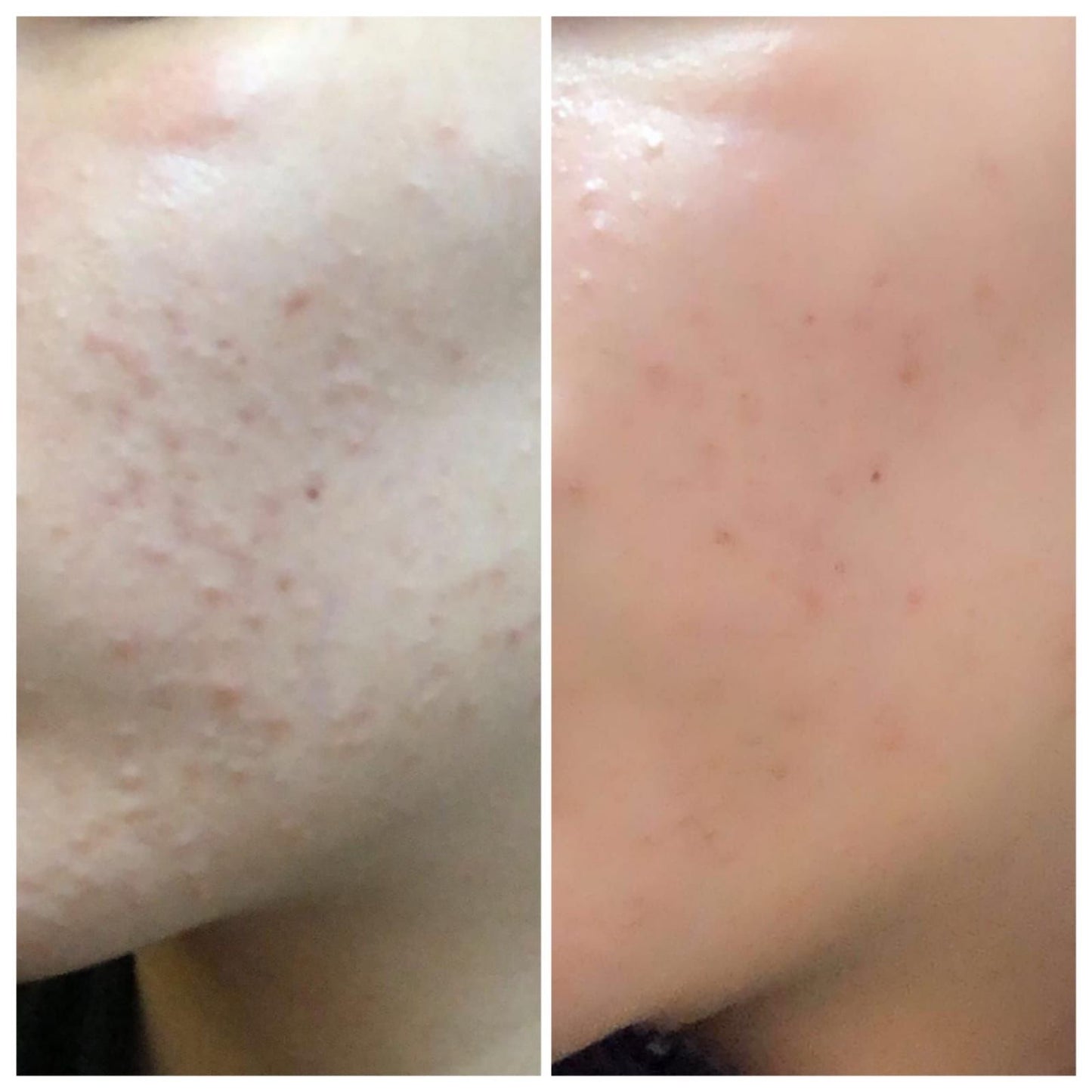 Glamista Peeling 20%