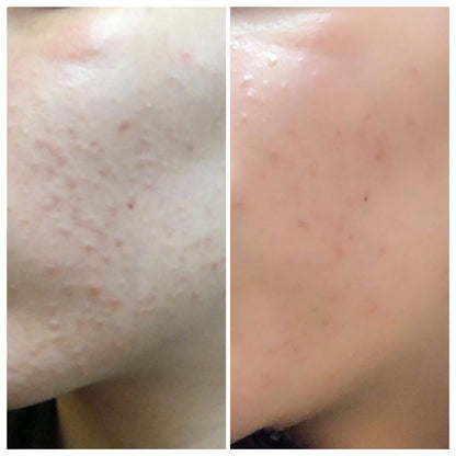 Glamista Peeling 20%