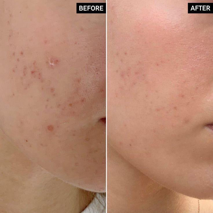 Glamista Peeling 20%