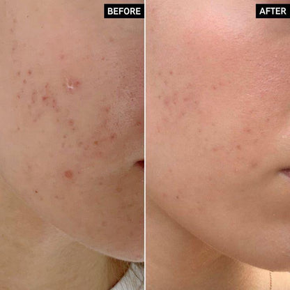Glamista Peeling 20%