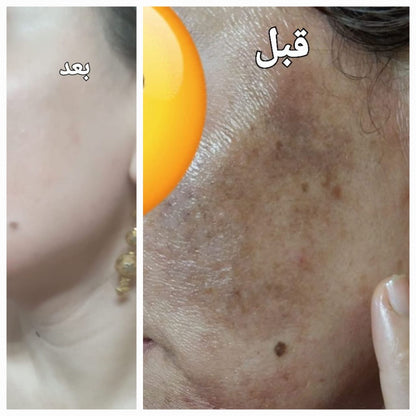 Glamista Peeling 20%