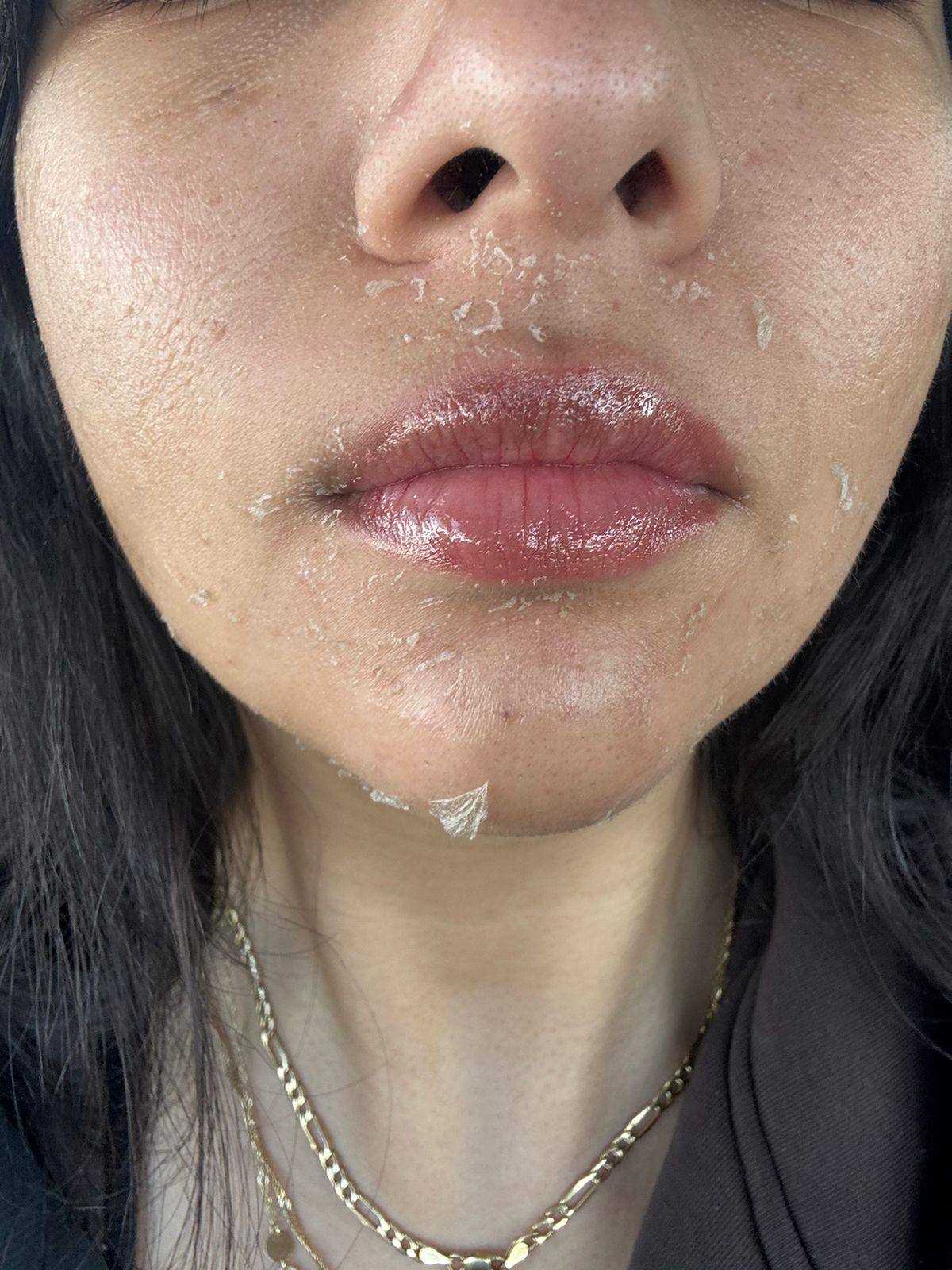 تقشير بارد لحوالين الفم