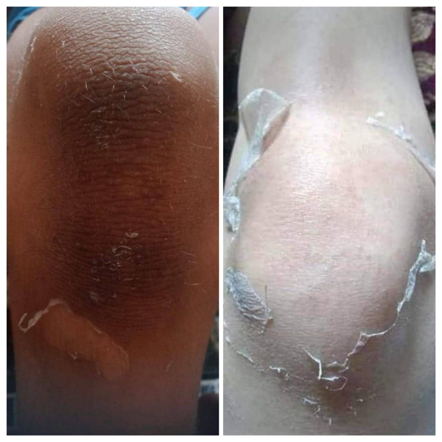 Glamista Peeling 60%