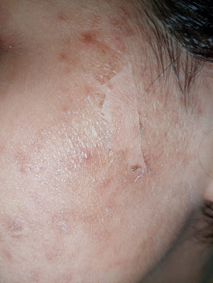 Glamista Peeling 20%